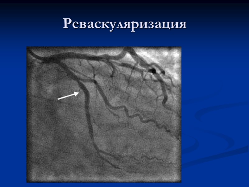 Реваскуляризация